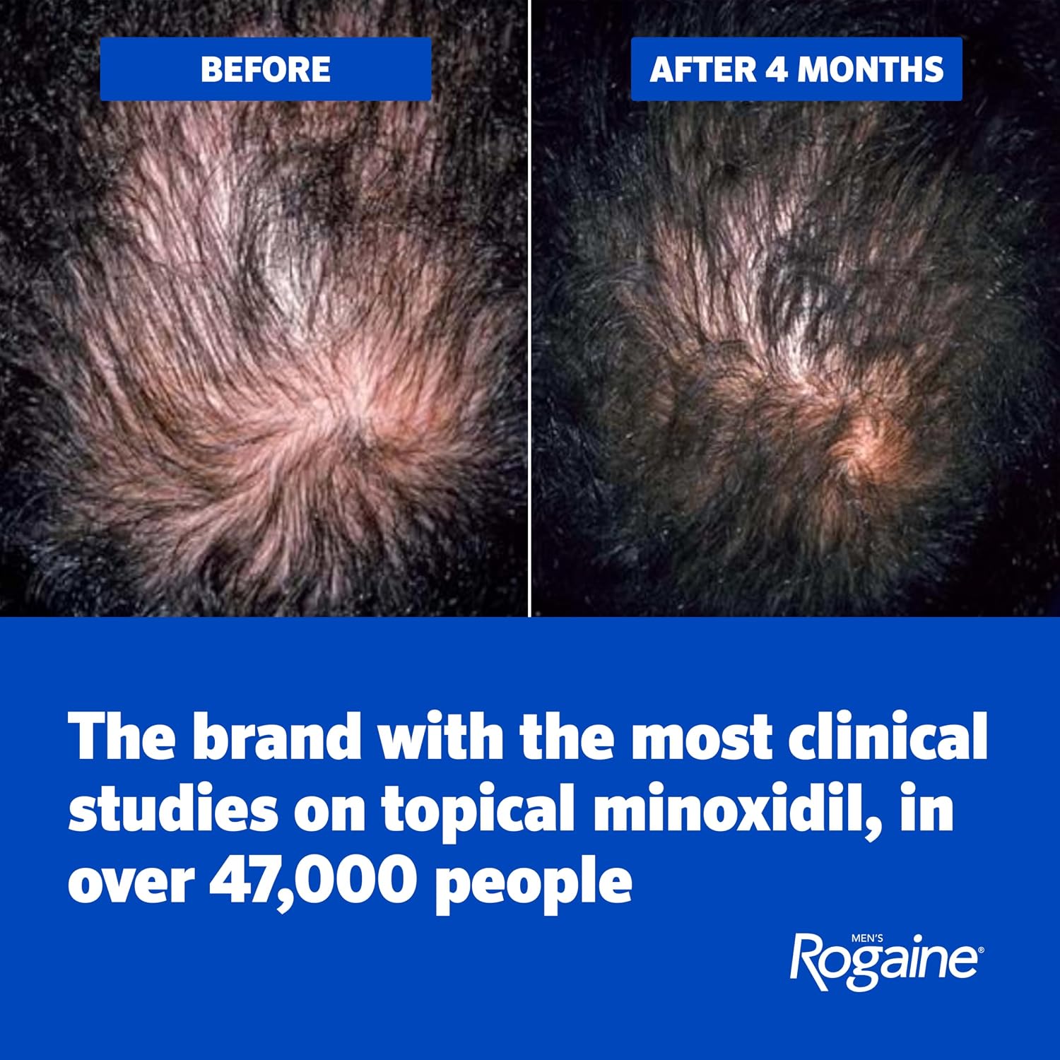 Rogaine Forte Minoxidil 3 x 60 ML - Image 3